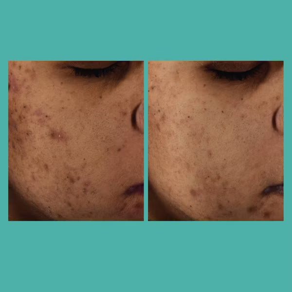 L'ORÉAL PARIS Bright Reveal Niacinamide Dark Spot Serum, 1 fl oz