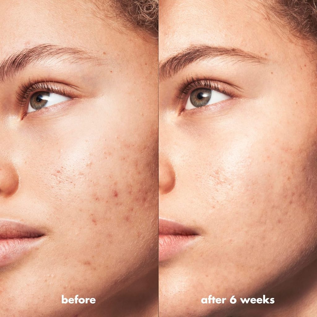 e.l.f. SKIN Blemish Breakthrough Acne Calming Water Cream-609332575639-LR-347887-4-LR eShop