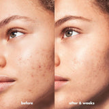 e.l.f. SKIN Blemish Breakthrough Acne Calming Water Cream-609332575639-LR-347887-4-LR eShop