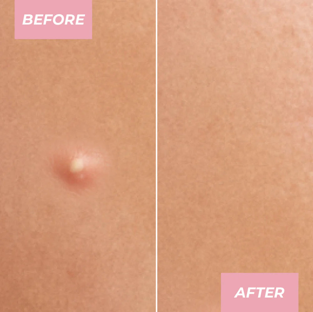 MCoBeauty Miracle Pimple Patch-9331880022426-LR-353605-9-LR eShop