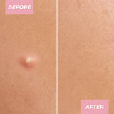 MCoBeauty Miracle Pimple Patch-9331880022426-LR-353605-9-LR eShop